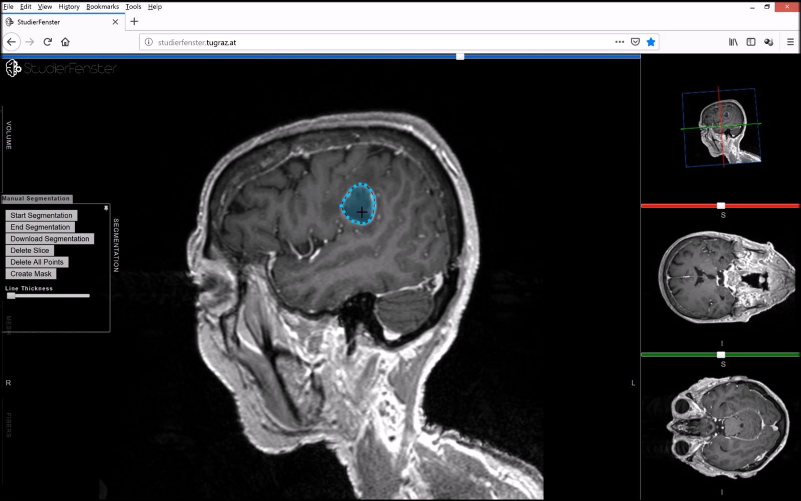 Polski neurochirurg w elitarnym gronie. Pracuje nad terapią glejaka